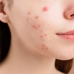 Don't Let Acne Control Your Life: Tips for Prevention and Management - thatnatureworld