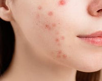 Don't Let Acne Control Your Life: Tips for Prevention and Management - thatnatureworld