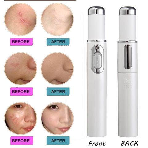 Blue Light Therapy Acne Laser Pen Soft Scar Wrinkle Removal Treatment Device Skin Care Beauty Equipment - thatnatureworld