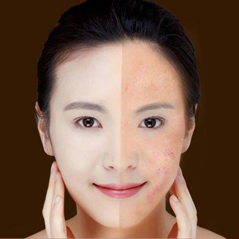 Blue Light Therapy Acne Laser Pen Soft Scar Wrinkle Removal Treatment Device Skin Care Beauty Equipment - thatnatureworld