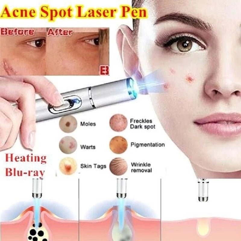 Blue Light Therapy Acne Wrinkle Removal Laser Pen. Repairing Beauty Machine for Dark Spots Elasticity Tightening Facial Ideal Gift for Women - thatnatureworld